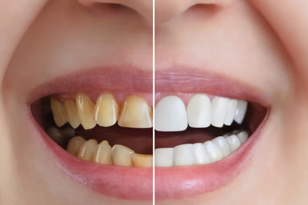 How Fluoride Protects Your Teeth