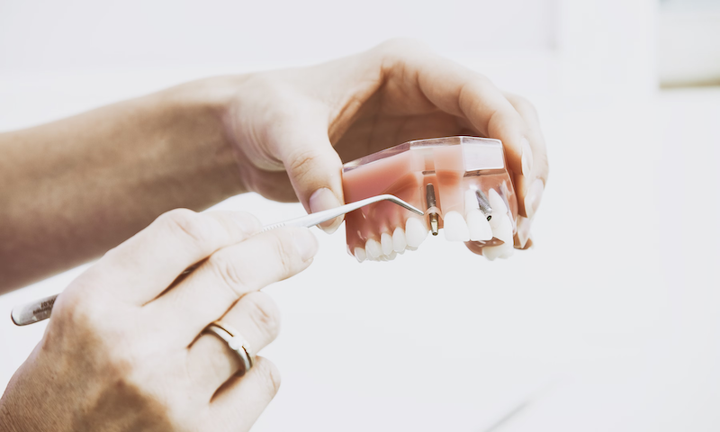 Avoiding Dental Erosion: Tips You Need to Know