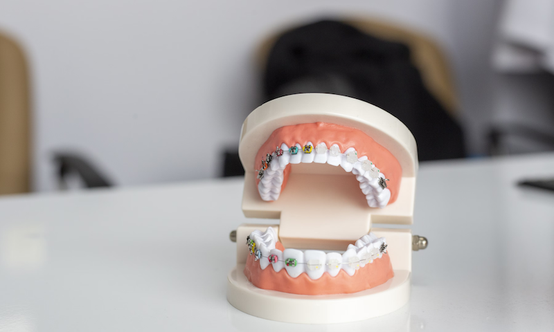 The Science Behind Teeth Whitening
